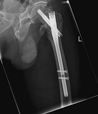 Hip Intertrochanteric IMN Lateral